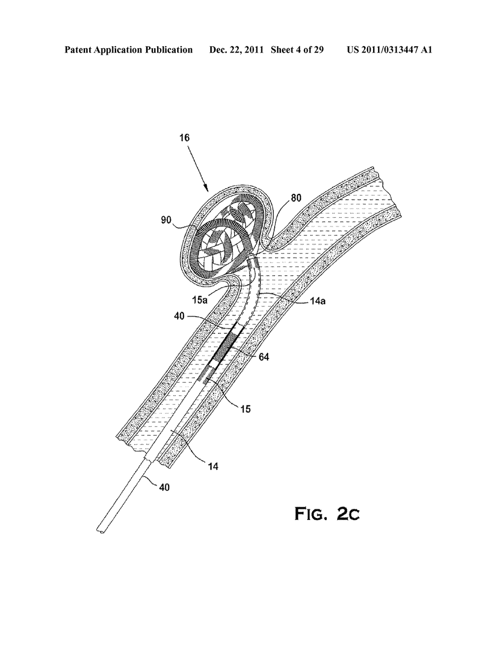 SYSTEM AND METHOD FOR MECHANICALLY POSITIONING INTRAVASCULAR IMPLANTS - diagram, schematic, and image 05