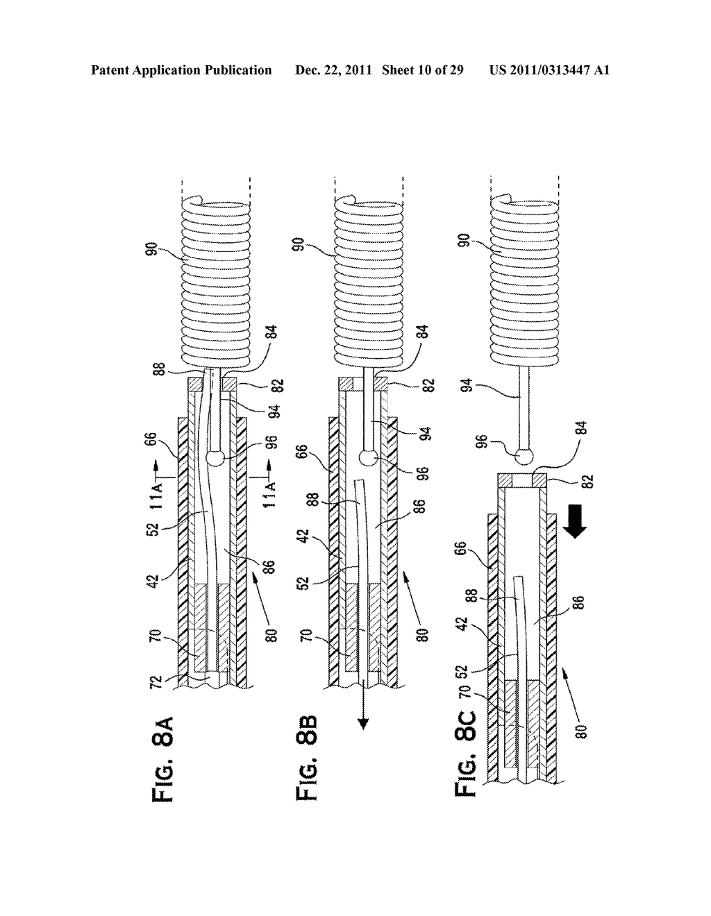 SYSTEM AND METHOD FOR MECHANICALLY POSITIONING INTRAVASCULAR IMPLANTS - diagram, schematic, and image 11