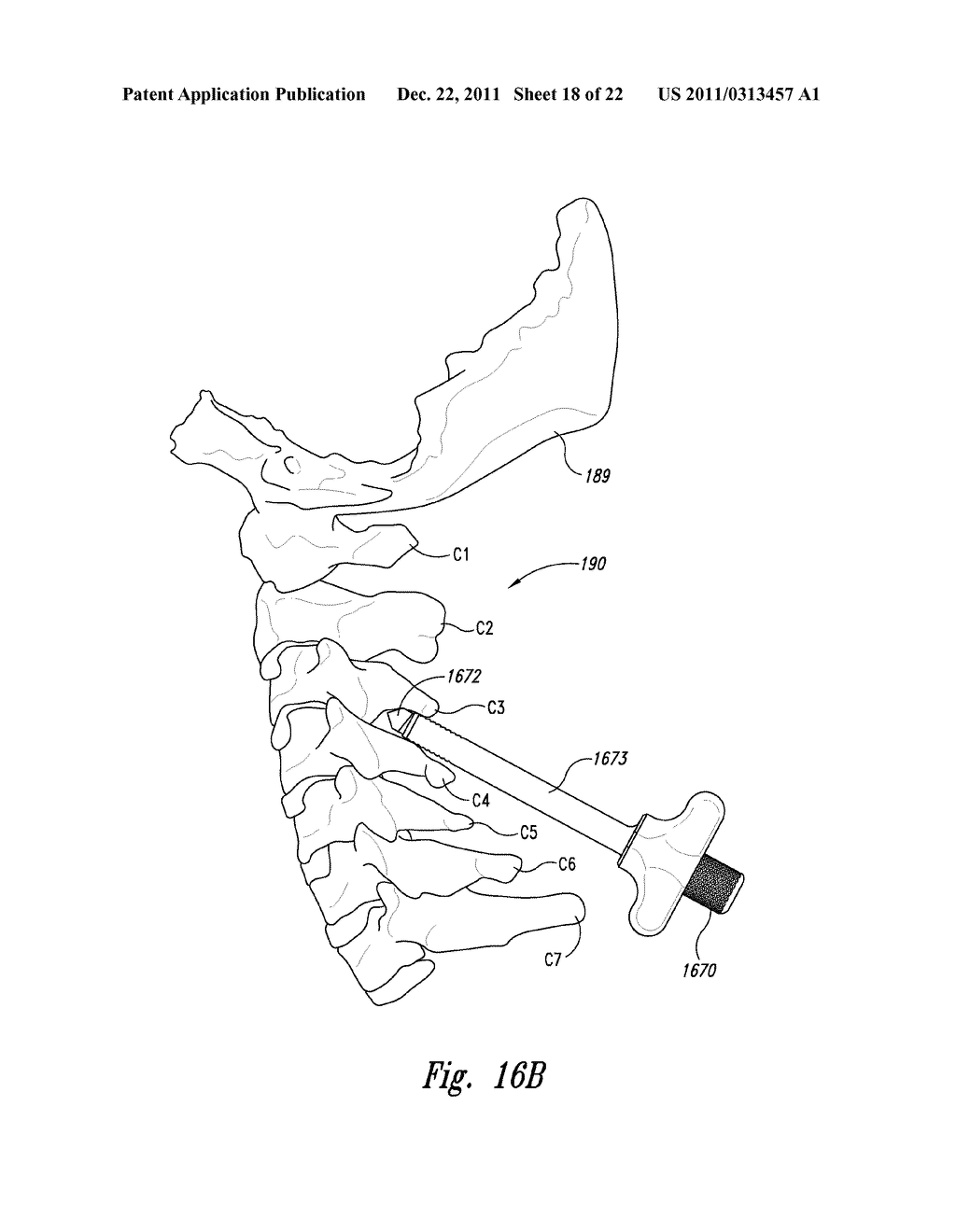 SPINAL SPACER FOR CERVICAL AND OTHER VERTEBRA, AND ASSOCIATED SYSTEMS AND     METHODS - diagram, schematic, and image 19