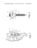 System for Percutaneously Fixing a Connecting Rod to a Spine diagram and image