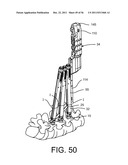 System for Percutaneously Fixing a Connecting Rod to a Spine diagram and image