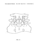 METHOD AND APPARATUS FOR SPINAL STABILIZATION diagram and image