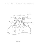 METHOD AND APPARATUS FOR SPINAL STABILIZATION diagram and image