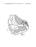 Devices and Methods for Vestibular and/or Cranial Nerve Stimulation diagram and image