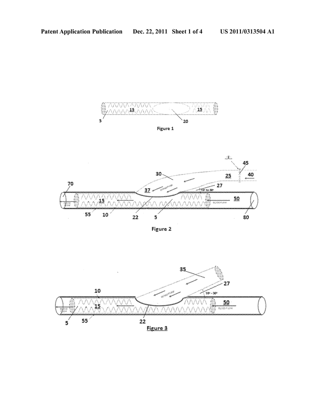 DEVICE AND METHOD TO PREVENT  OR TREAT OUTFLOW VEIN STENOSIS OF AN     ARTERIOVENOUS FISTULA CONSTRUCTED WITH A SYNTHETIC VASCULAR GRAFT - diagram, schematic, and image 02