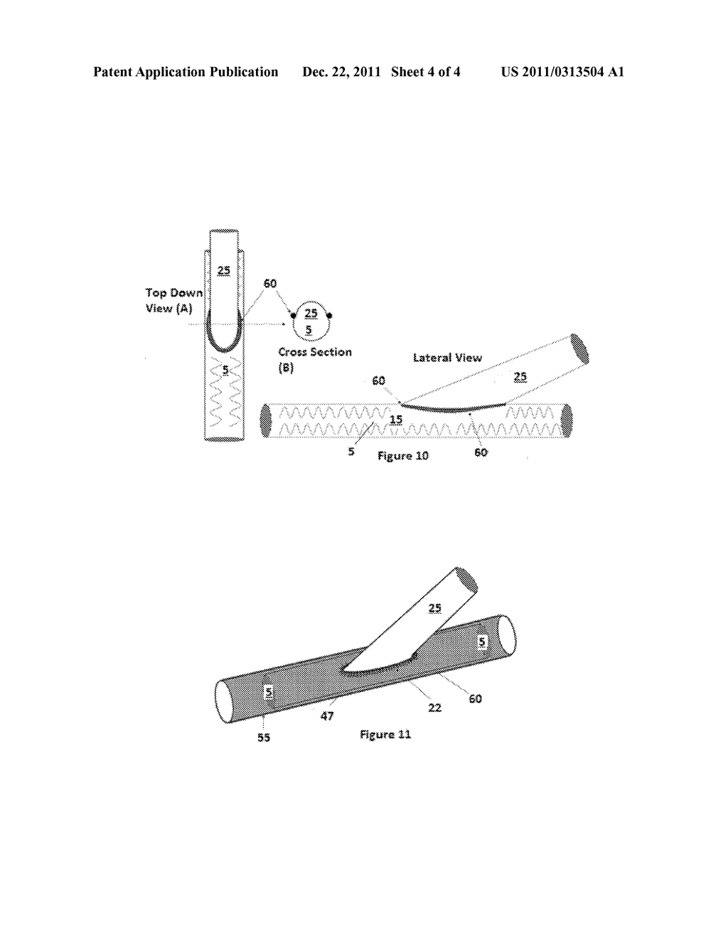 DEVICE AND METHOD TO PREVENT  OR TREAT OUTFLOW VEIN STENOSIS OF AN     ARTERIOVENOUS FISTULA CONSTRUCTED WITH A SYNTHETIC VASCULAR GRAFT - diagram, schematic, and image 05