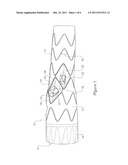 Side Branch Stent Graft diagram and image