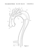 Side Branch Stent Graft diagram and image