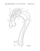 Side Branch Stent Graft diagram and image