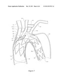 Side Branch Stent Graft diagram and image