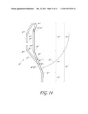 REPLACEMENT HEART VALVE diagram and image