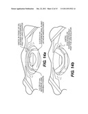 Pseudophakic Accommodating Intraocular Lens diagram and image