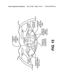 Pseudophakic Accommodating Intraocular Lens diagram and image