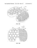 BONE IMPLANT INTERFACE SYSTEM AND METHOD diagram and image