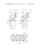 BONE IMPLANT INTERFACE SYSTEM AND METHOD diagram and image