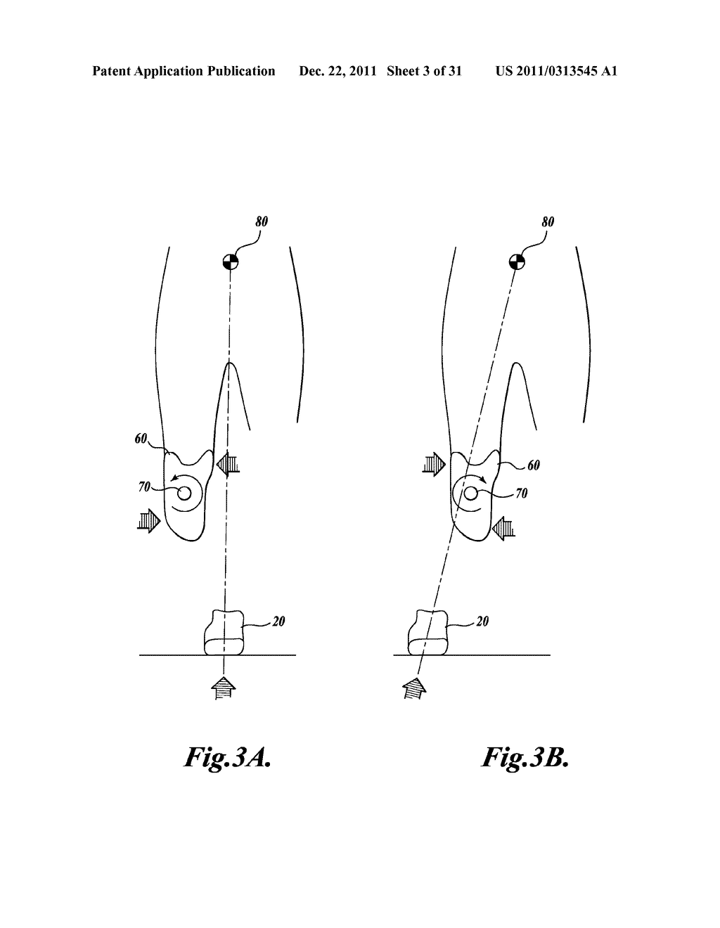 METHOD FOR ALIGNING A PROSTHESIS - diagram, schematic, and image 04