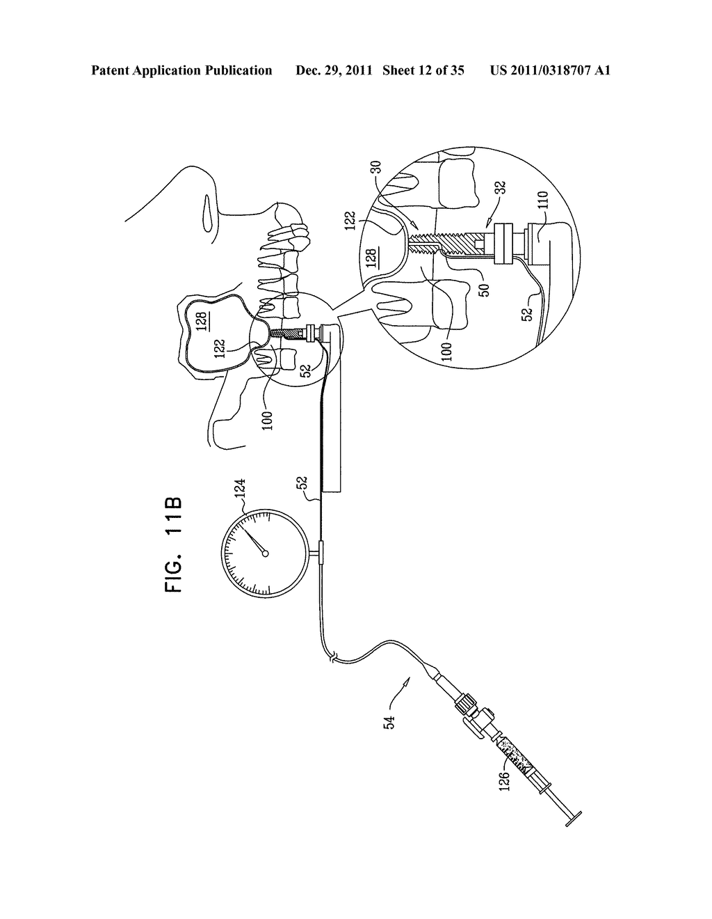 DENTAL IMPLANT HAVING A RECESSED SURFACE FOR SEALING - diagram, schematic, and image 13