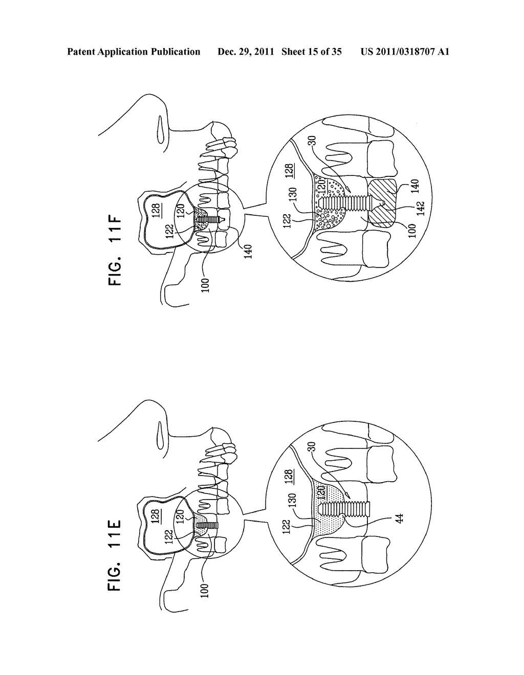 DENTAL IMPLANT HAVING A RECESSED SURFACE FOR SEALING - diagram, schematic, and image 16