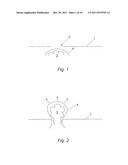 SURGICAL IMPLANT diagram and image