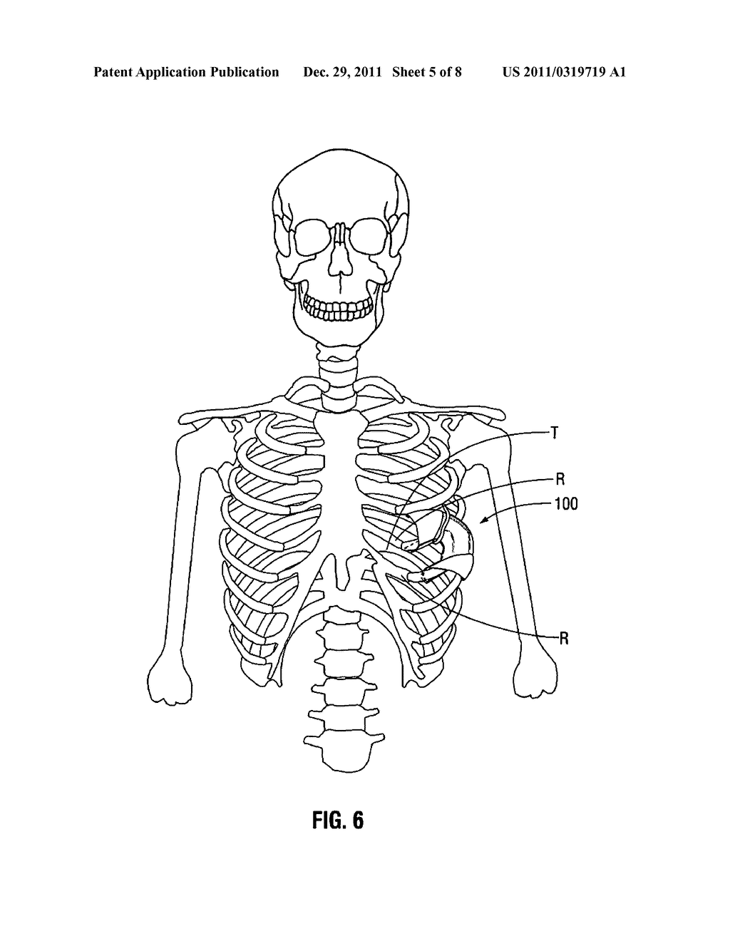 THORACIC ACCESS PORT - diagram, schematic, and image 06