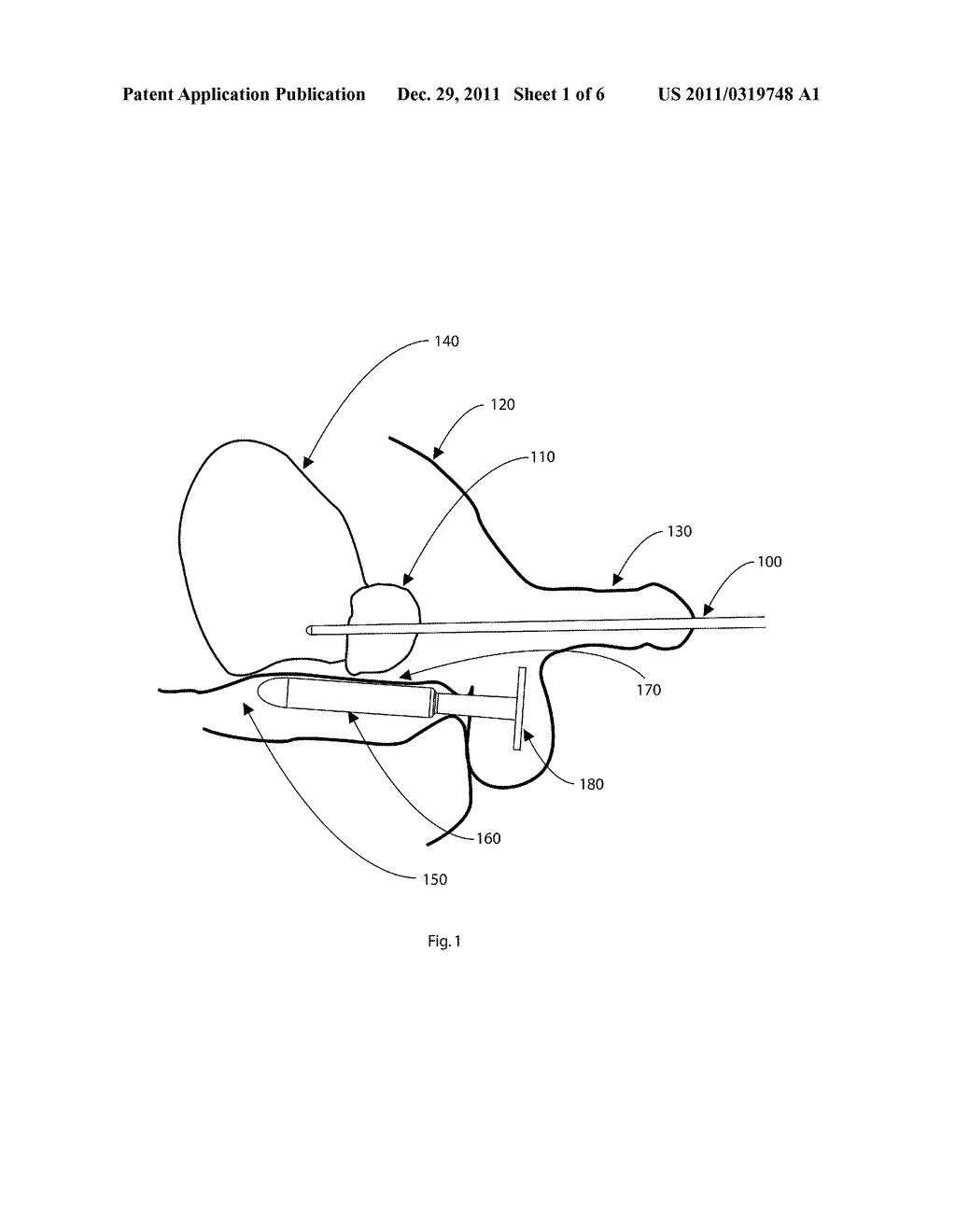 Apparatus and Method for Cooling a Tissue Volume During Thermal Therapy     Treatment - diagram, schematic, and image 02