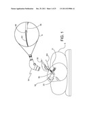 Ocular Implants Deployed in Schlemm s Canal of the Eye diagram and image