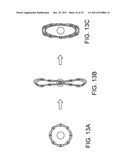 Ocular Implants Deployed in Schlemm s Canal of the Eye diagram and image