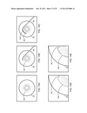 Ocular Implants Deployed in Schlemm s Canal of the Eye diagram and image