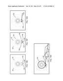 Ocular Implants Deployed in Schlemm s Canal of the Eye diagram and image