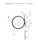 Ocular Implants Deployed in Schlemm s Canal of the Eye diagram and image