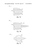 CATHETER DEVICE FOR DELIVERY ENERGY TO A VEIN diagram and image