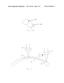 Method for Laser Cutting a Corneal Pocket diagram and image