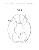 Red Light Implants for Treating Postpartum Depression diagram and image