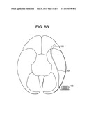 Red Light Implants for Treating Postpartum Depression diagram and image