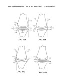 Patient Selectable Joint Arthroplasty Devices and Surgical Tools diagram and image