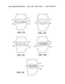 Patient Selectable Joint Arthroplasty Devices and Surgical Tools diagram and image