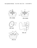 Patient Selectable Joint Arthroplasty Devices and Surgical Tools diagram and image