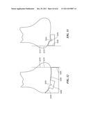 Patient Selectable Joint Arthroplasty Devices and Surgical Tools diagram and image