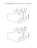 Patient Selectable Joint Arthroplasty Devices and Surgical Tools diagram and image