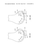 Patient Selectable Joint Arthroplasty Devices and Surgical Tools diagram and image