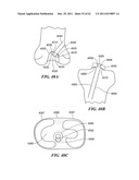 Patient Selectable Joint Arthroplasty Devices and Surgical Tools diagram and image