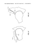 Patient Selectable Joint Arthroplasty Devices and Surgical Tools diagram and image