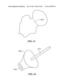 Patient Selectable Joint Arthroplasty Devices and Surgical Tools diagram and image