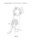 Patient Selectable Joint Arthroplasty Devices and Surgical Tools diagram and image