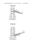 Instruments and Methods for Non-Parallel Disc Space Preparation diagram and image