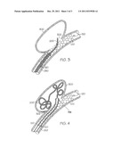 Sacrificial Anode Stent System diagram and image