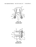 Robot Guided Oblique Spinal Stabilization diagram and image