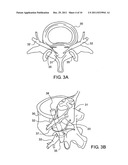 Robot Guided Oblique Spinal Stabilization diagram and image