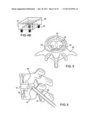 Robot Guided Oblique Spinal Stabilization diagram and image