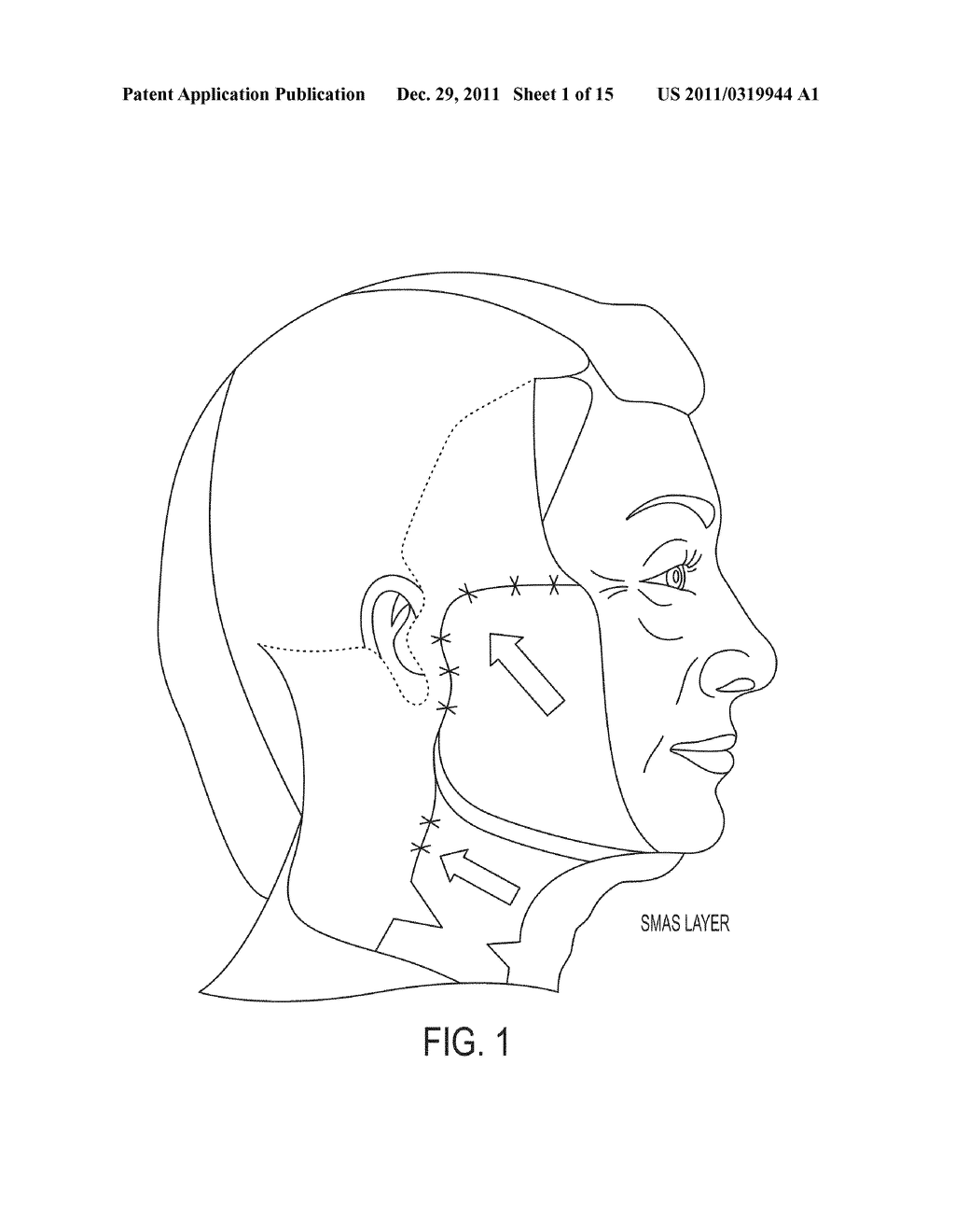 Submuscular Facial Fixation (Myo-Osseous Fixation) Using Microincision     Microscrew Device, Injectable Glues and Adhesives, and Method and Device     for Therapy of Migraine and Related Headaches - diagram, schematic, and image 02